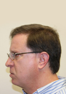 hair transplant photos