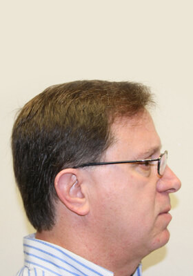 hair transplant photos