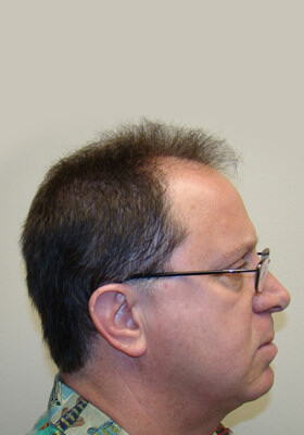 hair transplant before after Photos