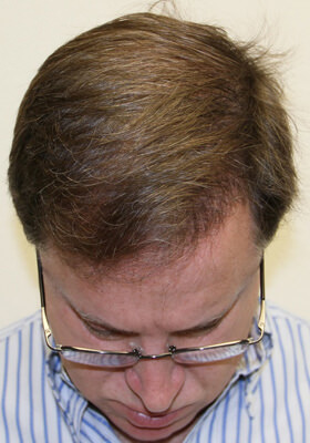 hair transplant photos