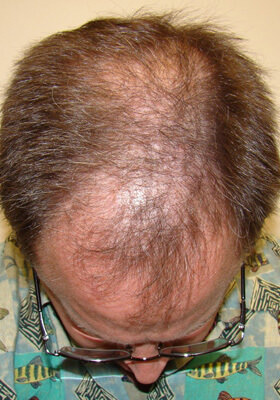 hair transplant before after Photos