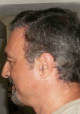 hair transplant photos