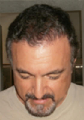 hair transplant photos