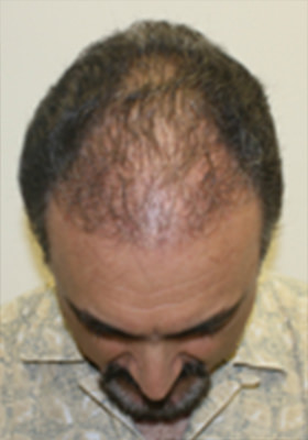 hair transplant before after Photos