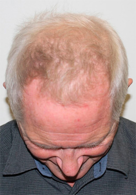 hair transplant photos