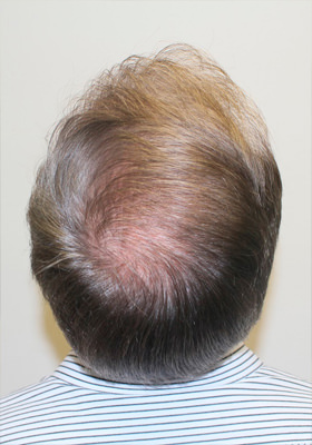 hair transplant photos