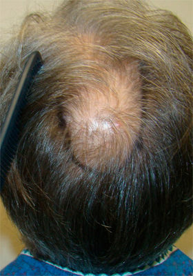 hair transplant photos