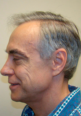 hair transplant photos