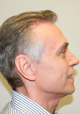 hair transplant before after Photos