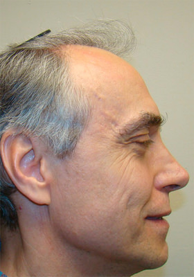 hair transplant photos