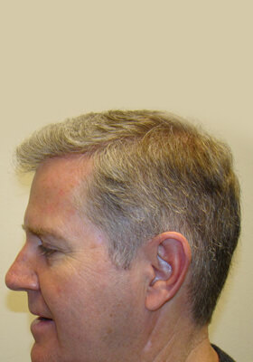 hair transplant photos