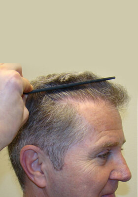 hair transplant photos