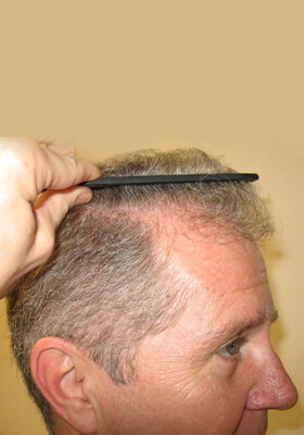 hair transplant photos