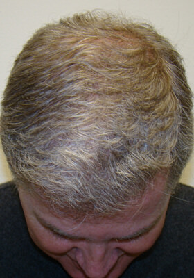 hair transplant before after Photos