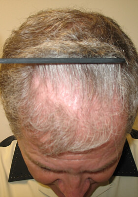 hair transplant before after Photos