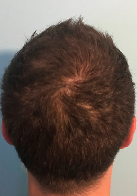 hair transplant photos