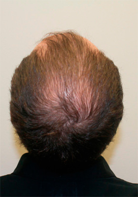 hair transplant photos