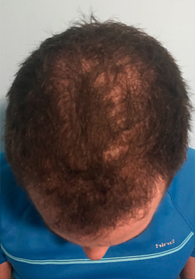 hair transplant photos