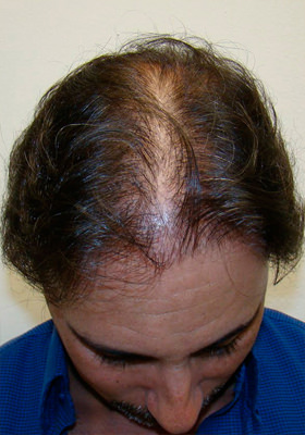 hair transplant photos