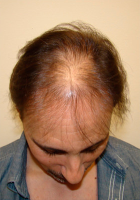 hair transplant before after Photos