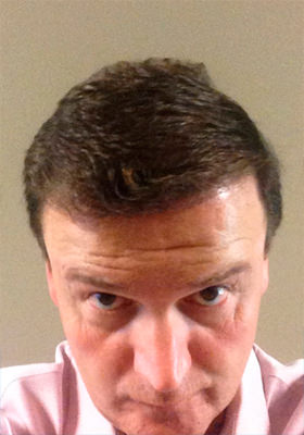 hair transplant photos