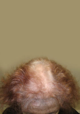 hair transplant photos