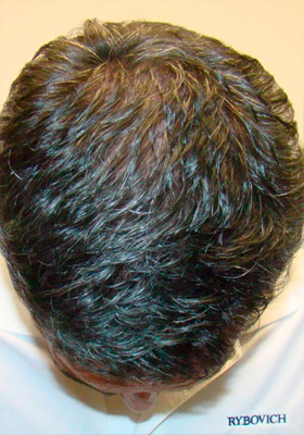 hair transplant photos