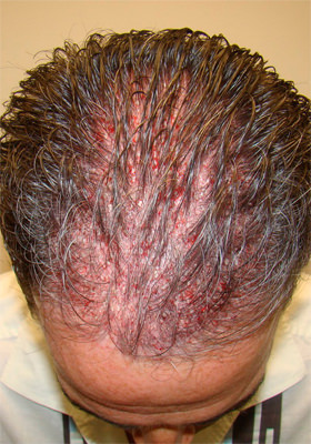 hair transplant before after Photos