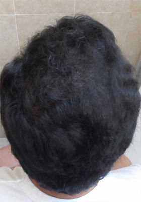 hair transplant before after Photos