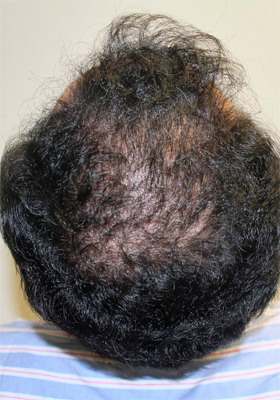 hair transplant photos