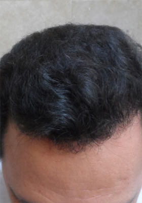 hair transplant before after Photos