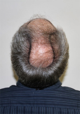 hair transplant before after Photos