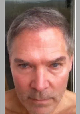 hair transplant photos