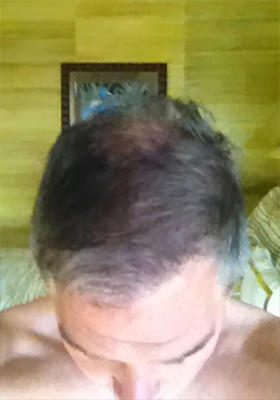 hair transplant before after Photos