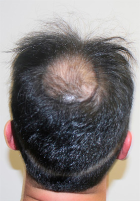 hair transplant before after Photos