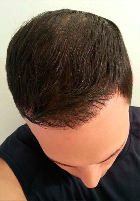 hair transplant photos