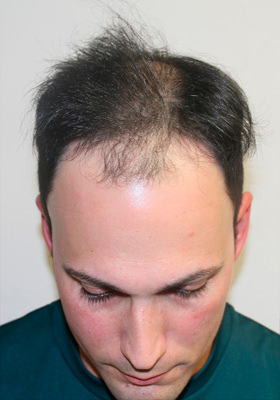 hair transplant before after Photos