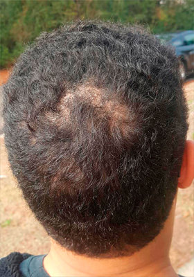 hair transplant photos