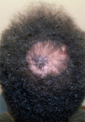 hair transplant photos