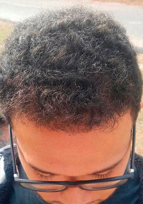 hair transplant photos