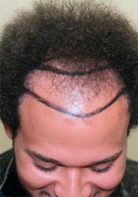 hair transplant before after Photos