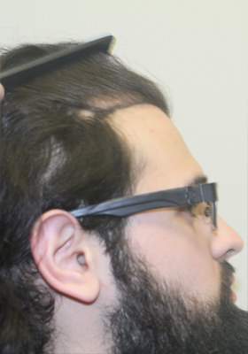 hair transplant before after Photos