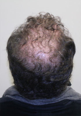 hair transplant before after Photos