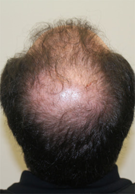 hair transplant before after Photos