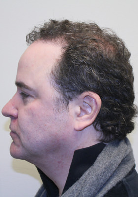 hair transplant before after Photos