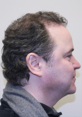 hair transplant before after Photos