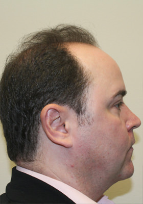 hair transplant before after Photos