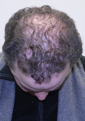 hair transplant before after Photos