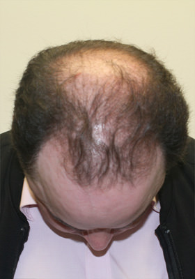 hair transplant before after Photos