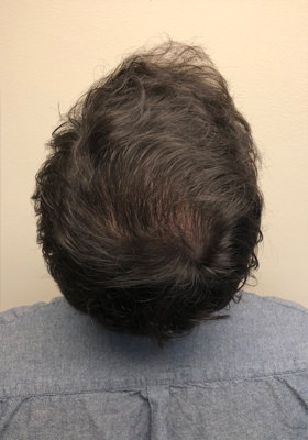 hair transplant before after Photos